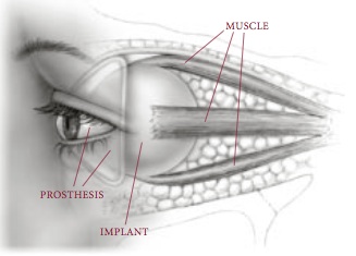 An image of Enucleation Eviseration