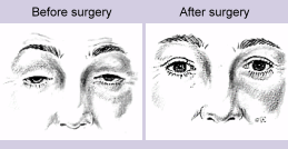 Before and After image of Ptosis Surgery "Droopy Eyelid" Repair