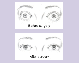 Before and After image of Thyroid Eye Disease and Treatment